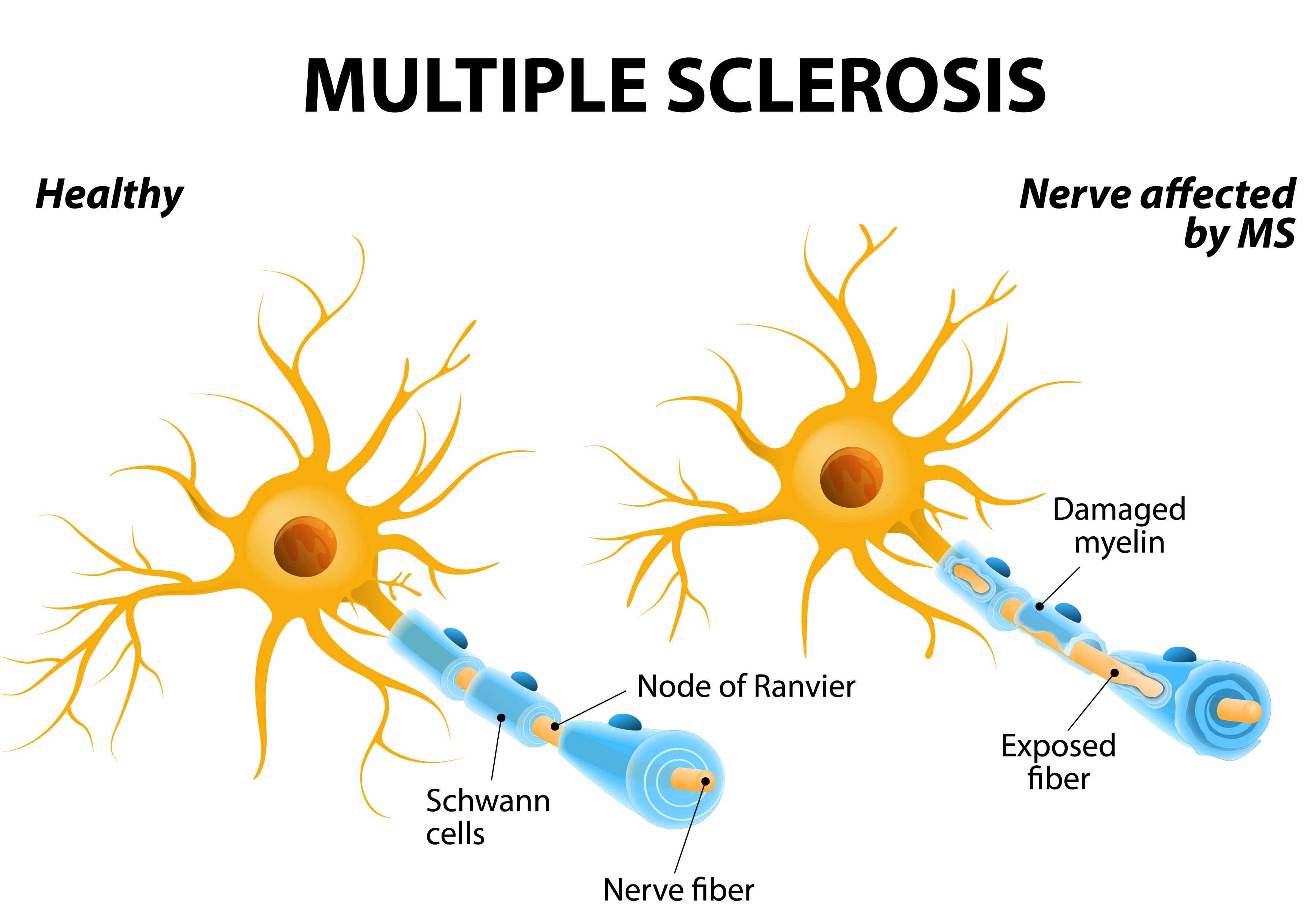 Gesundes Neuron vs. von Multipler Sklerose betroffenes Neuron. MS Neuron Unterschiede