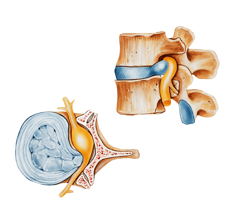 Back pain and degenerative disc disease nerve compression | ANOVA Germany Back pain and degenerative disc disease nerve compression | ANOVA