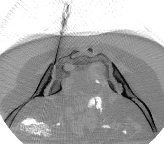 CT-gestützte Stammzellinjektion in Gelenke | ANOVA